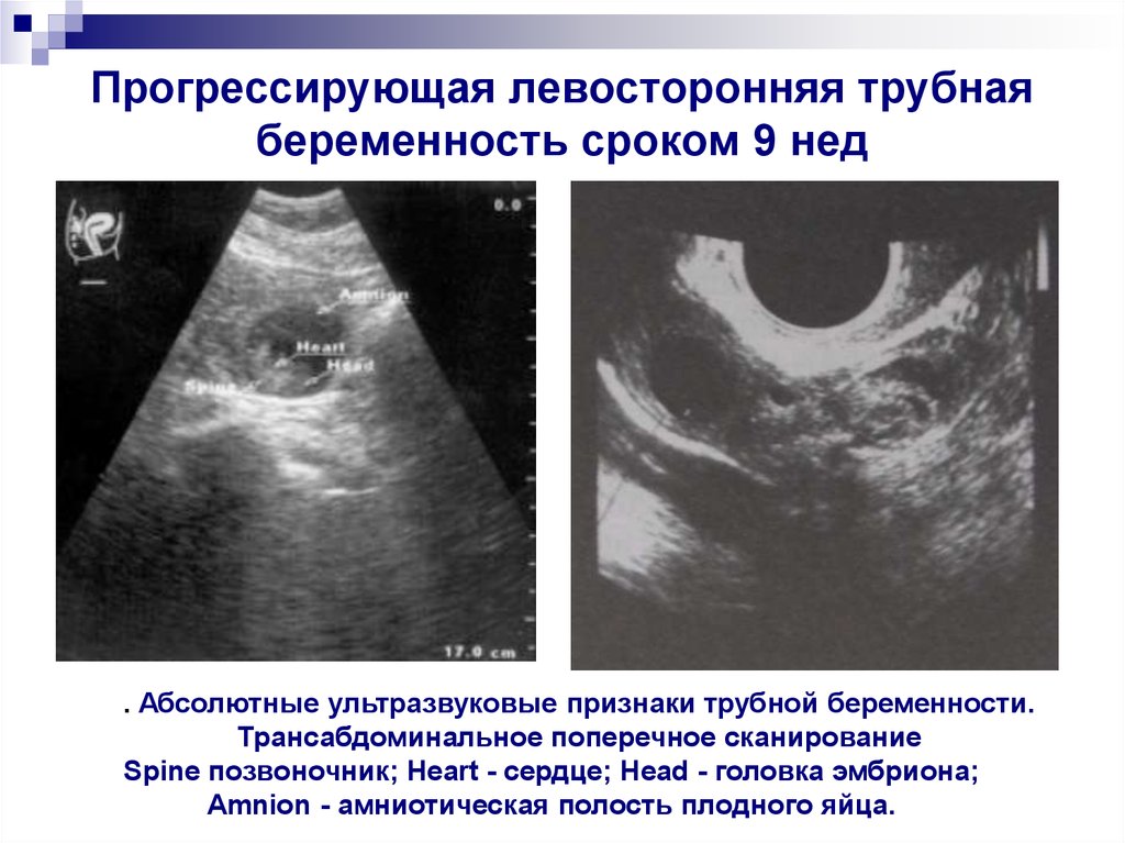 Внематочная беременность сохраняют ли. Разрыв маточной трубы на УЗИ. Внематочная Трубная беременность. Осложнения трубной беременности. Что такое маточные Трубная беременность.