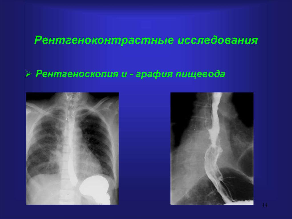 Графия это. Рентгеноконтрастное исследование. Рентгеноскопия перфорация пищевода. Рентгеноконтрастный шаблон.