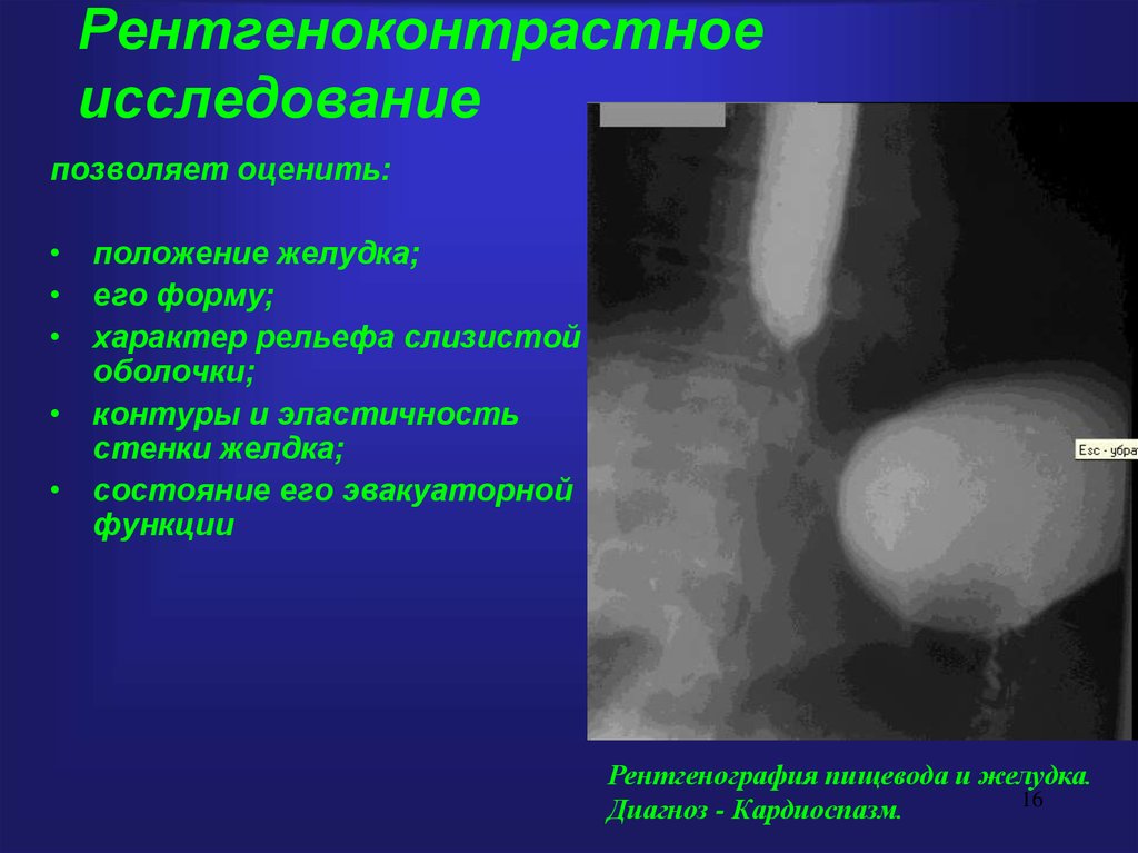 Рентгеноконтрастный барий. Рентгеноконтрастные методы исследования. Контрастные рентгенологические исследования. Рентгенологическое исследование желудка в норме. Рентгеноконтрастные методики в исследовании.