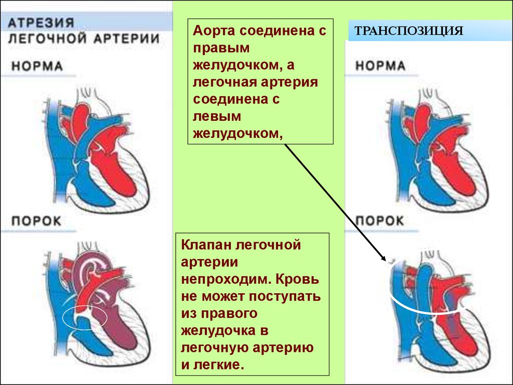 Ала сердца. Атрезия клапана легочной артерии. Типы атрезии легочной артерии. Атрезия легочной артерии 1 Тип ДМЖП. Атрезия легочной артерии 1-2 Тип.