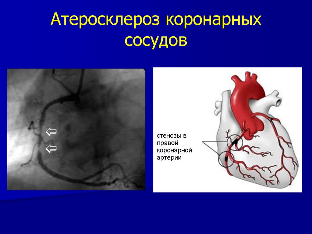 Ишемическая болезнь сосудов. Однососудистое атеросклеротическое поражение коронарных артерий. Ишемическая болезнь сердца атеросклероз коронарных артерий. Атеросклеротическое сужение коронарных артерий. Атеросклероз коранарних сосуд.