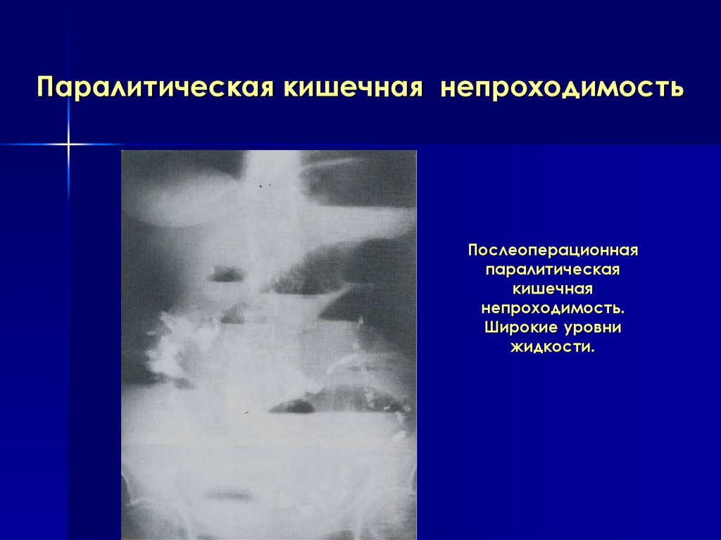 Паралитический илеус. Динамическая паралитическая кишечная непроходимость. Причины паралитической кишечной непроходимости. Динамическая кишечная непроходимость рентген. Рентген при паралитической кишечной непроходимости.