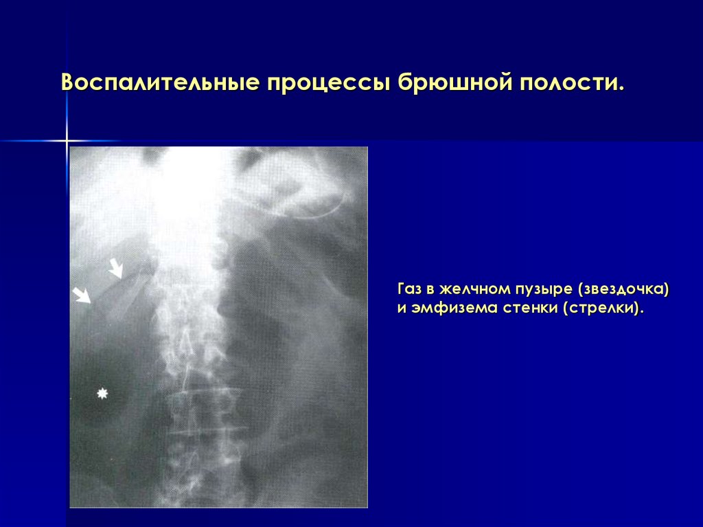 Рентген брюшной полости. Свободный ГАЗ В брюшной полости рентгенодиагностика. Рентген брюшной полости патологии. Прицельная рентгенограмма брюшной полости. Рентген брюшной полости с описанием.