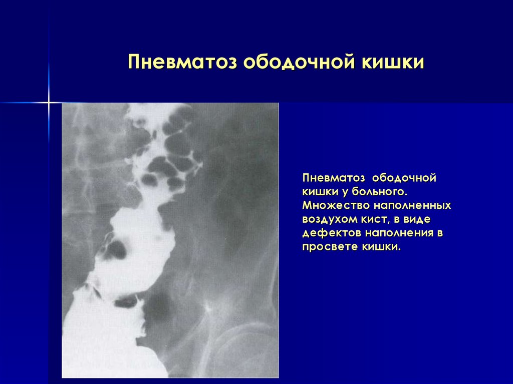 Пневматоз кишечника что это. Пневматоз тонкой кишки рентген. Пневматоз Толстого кишечника рентген. Пневматоз петель Толстого кишечника.