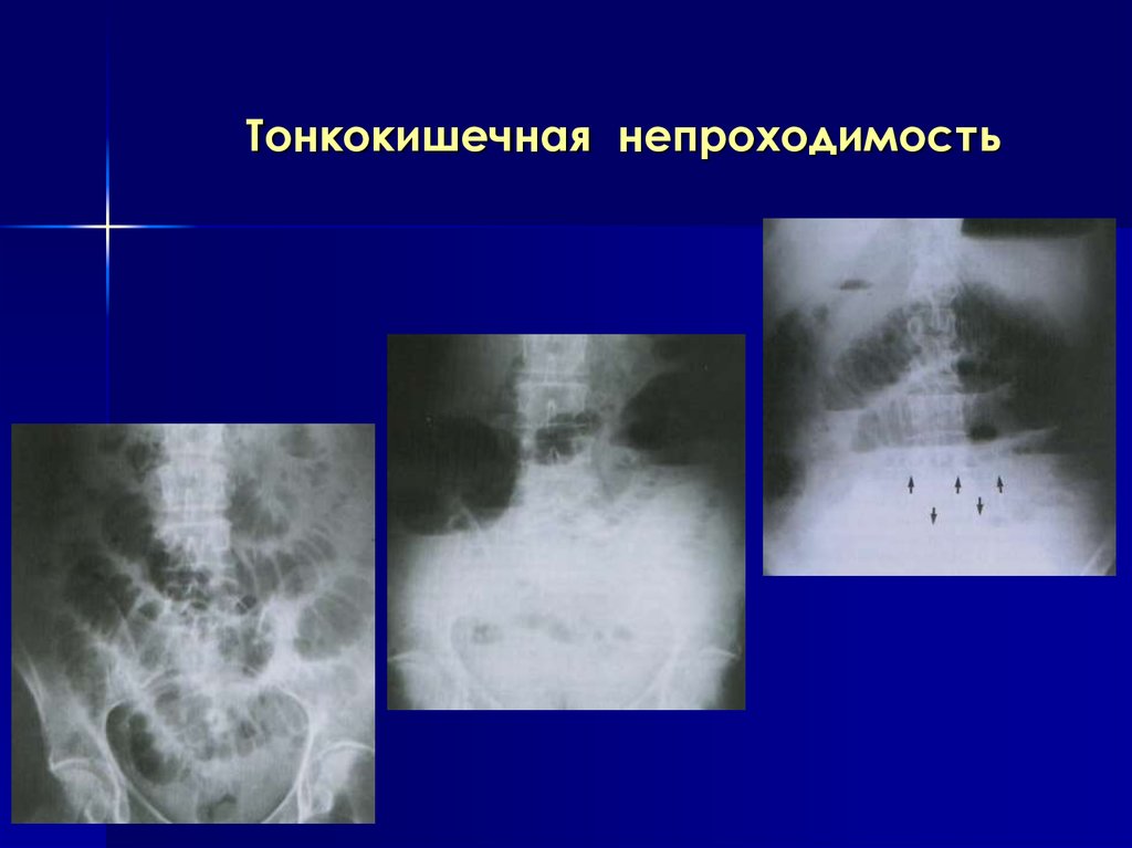 Непроходимость у взрослых. Тонкокишечная непроходимость рентген. Кишечная непроходимость рентген тонкокишечная. Обтурационная кишечная непроходимость рентген. Странгуляционная кишечная непроходимость рентген.