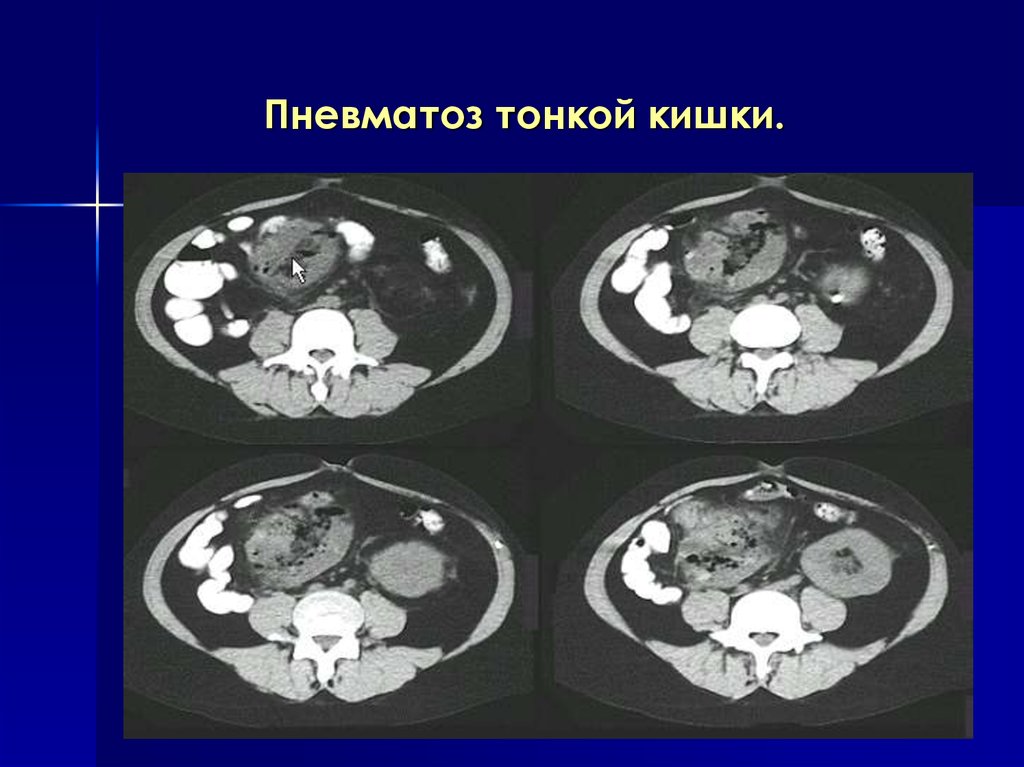 Пневматоз кишечника что это. Гиперпневматоз кишечника кт. Пневматоз ободочной кишки рентген. Гиперпневматоз ободочной кишки.