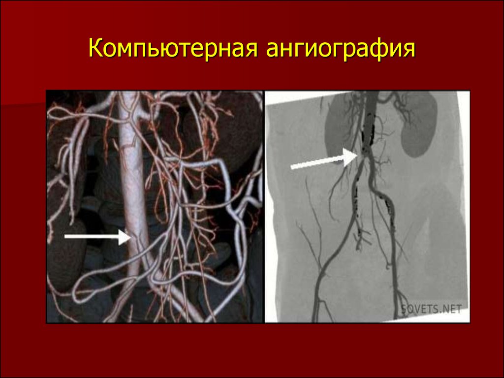 Ангиография. Компьютерная ангиография. Ангиография это метод. Диагностическая ангиография.