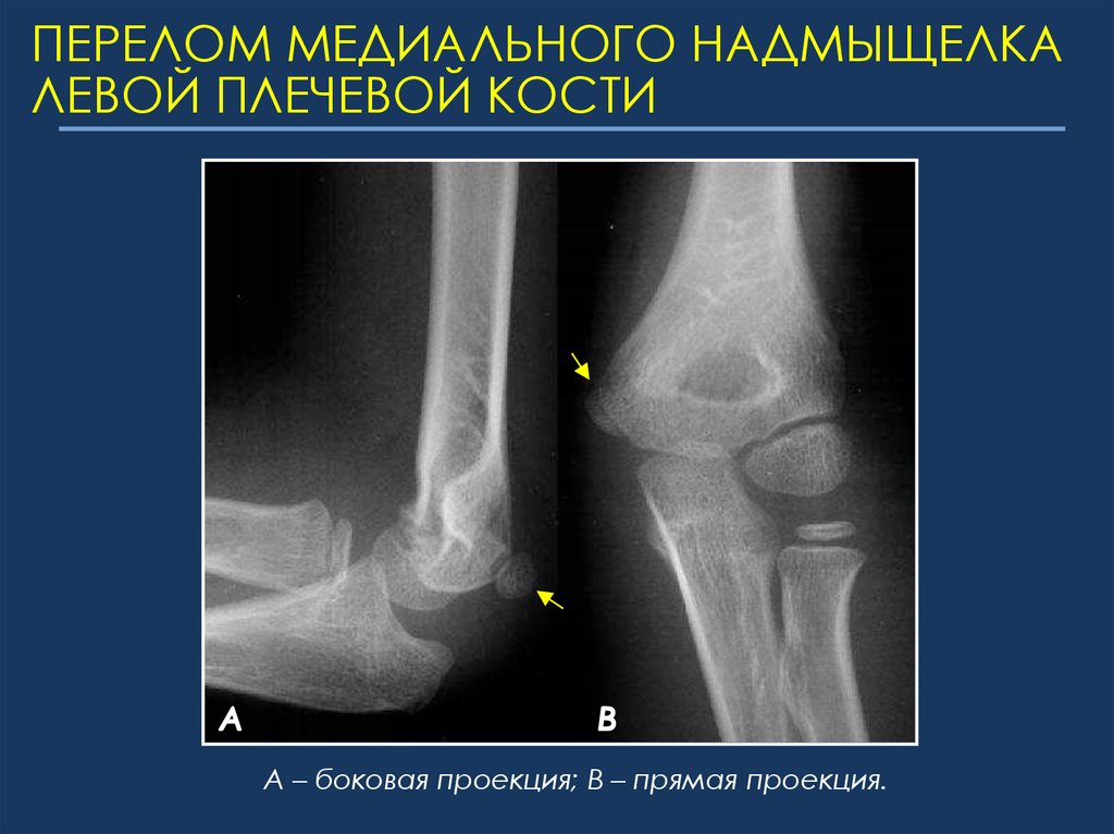 Медиальному надмыщелку кости