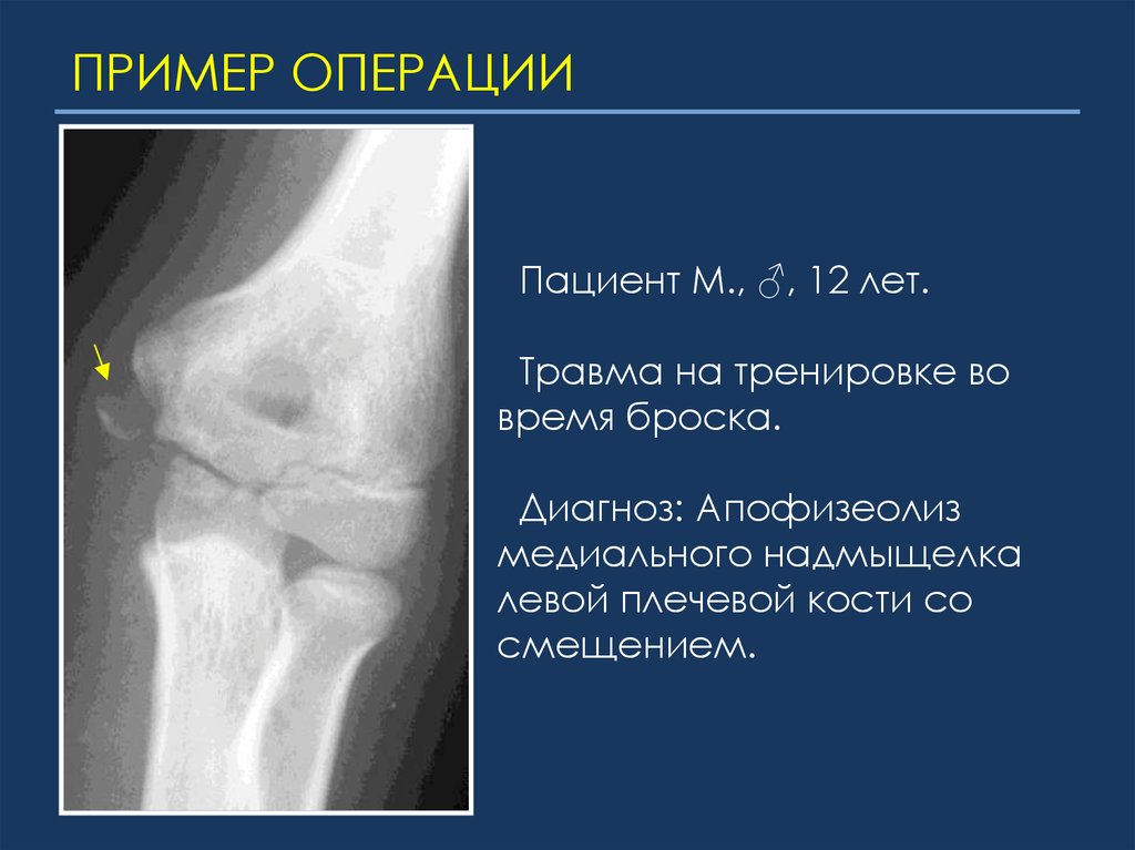 Отрывной перелом. Апофизиолиз локтевого сустава. Апофизеолиз и эпифизеолиз. Рентген надмыщелков плечевой кости. Апофизеолиз внутреннего надмыщелка.