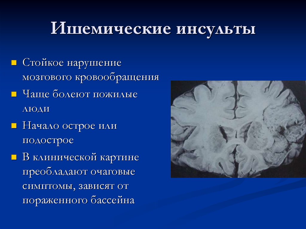 Ишемический инсульт что это такое. Ишемический инсульт головного мозга симптомы. Начало ишемического инсульта. Диагноз ишемический инсульт головного мозга. Лучевая картина ишемического инсульта.