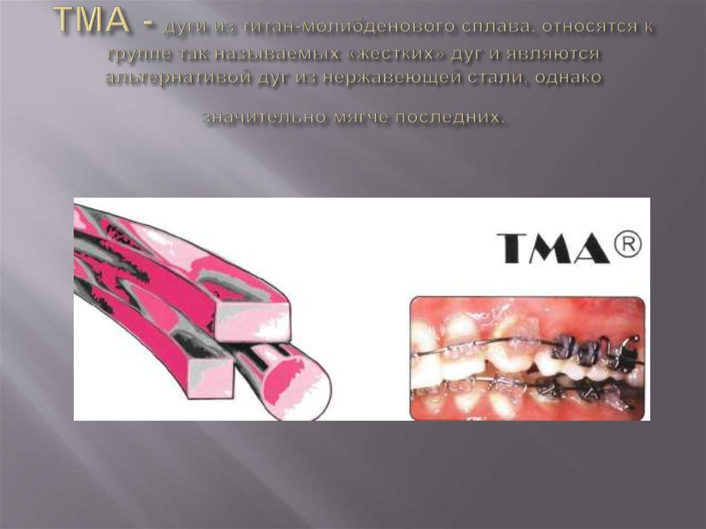 Виды дуг. Дуга TMA. Дуга ТМА В ортодонтии. Ортодонтические дуги Титан. Виды ортодонтических дуг.