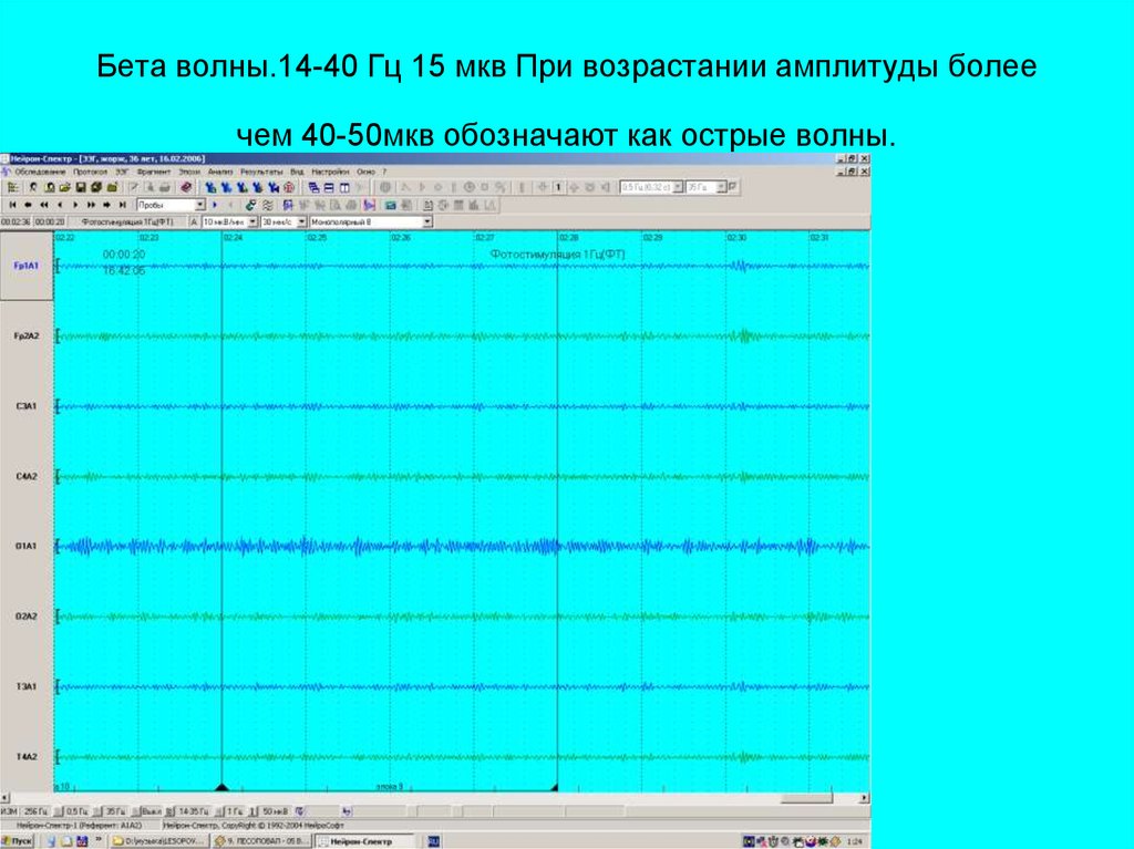 Мкв гц. Амплитуда МКВ. Амплитуда МКВ это в медицине. Бета активность асинхронная волна 15 МКВ. Бета волны применение.