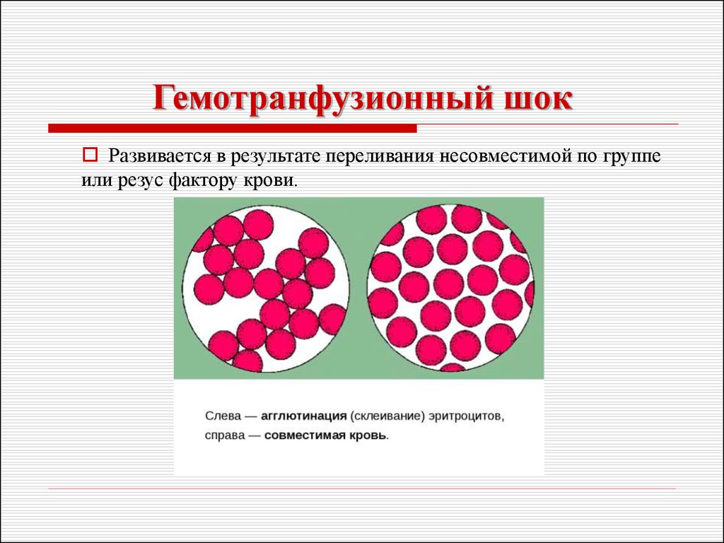 Гемотрансфузия группа крови. Гемотрансфузионный ШОК. Гемотрансфузионный ШОК при переливании крови. Гемотрансфузионный ШОК презентация. Гемотрансфузионный ШОК симптомы.