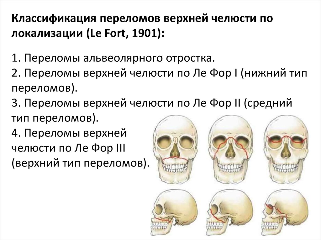 Переломы костей верхней челюсти. Лефор классификация переломов верхней челюсти. Классификация переломов челюстей лицевого скелета.. Классификация переломов нижней челюсти по Лефор.