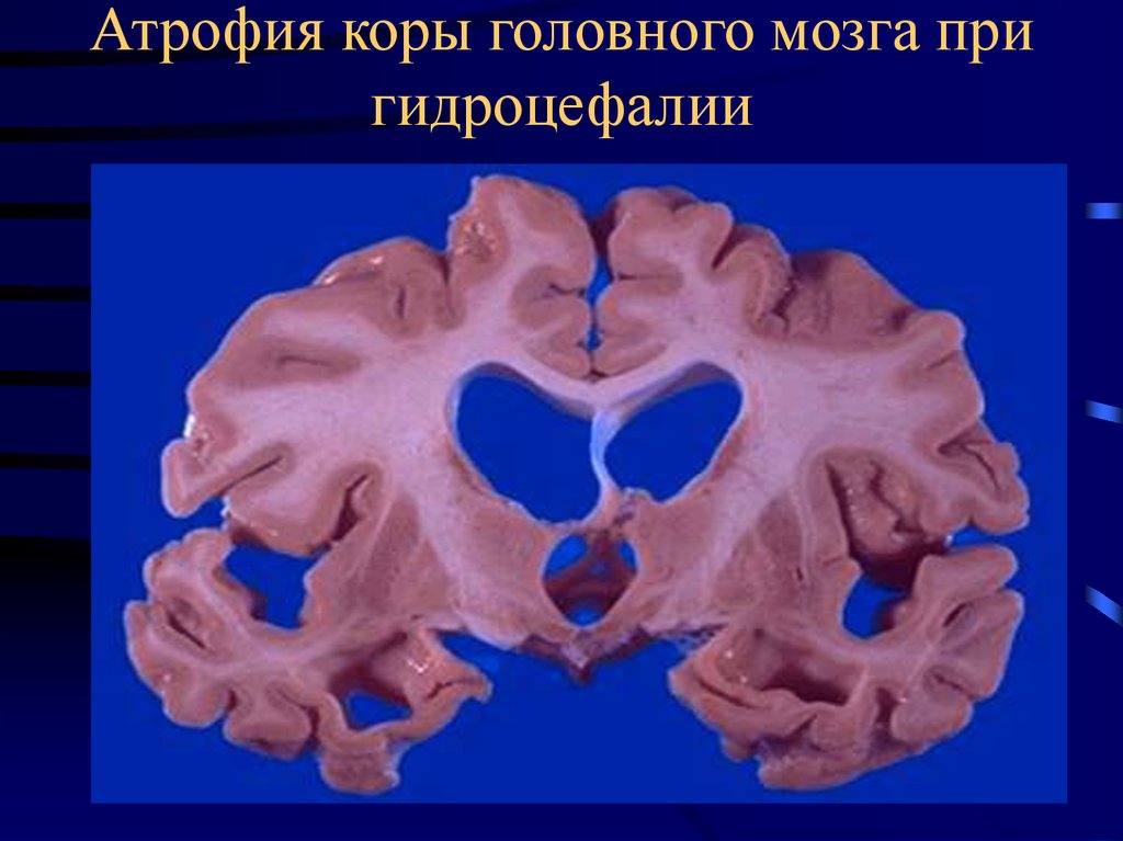 Атрофия головного мозга. Гидроцефалия патоморфология. Атрофия головного мозга макропрепарат гидроцефалия. Гидроцефалия препараты патанатомия. Атрофия головного мозга патанатомия.