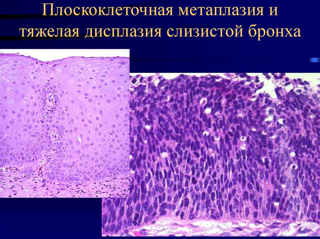 Метаплазия это. Сквамозная метаплазия эпителия. Дисплазия эпителия гистология. Дисплазия шейки матки микропрепарат. Плоскоклеточная метаплазия эпителия бронхов.