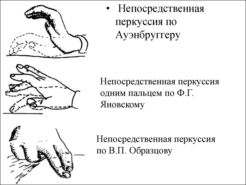 Перкуссия это. Метод посредственной и непосредственной перкуссии. Непосредственная перкуссия по Ауэнбруггеру. Перкуссию по в. п. Образцову. Непосредственная перкуссия по Яновскому.