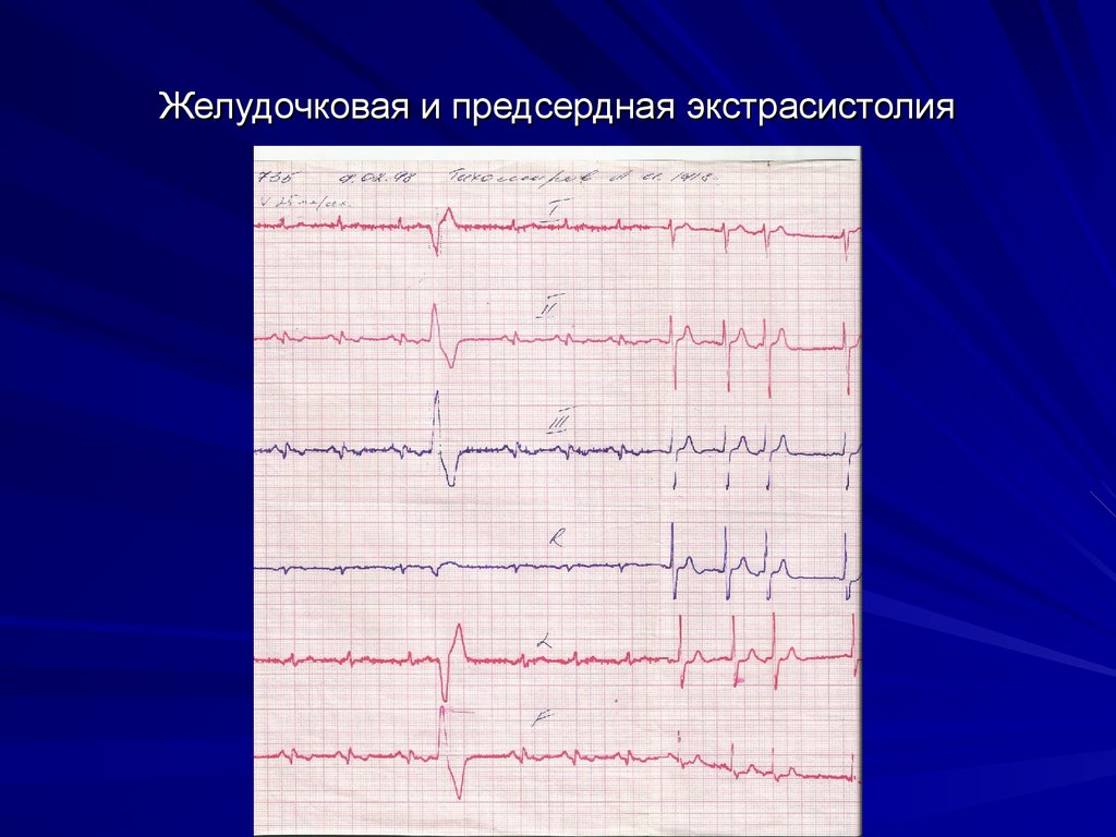 Желудочковая экстрасистолия картинки