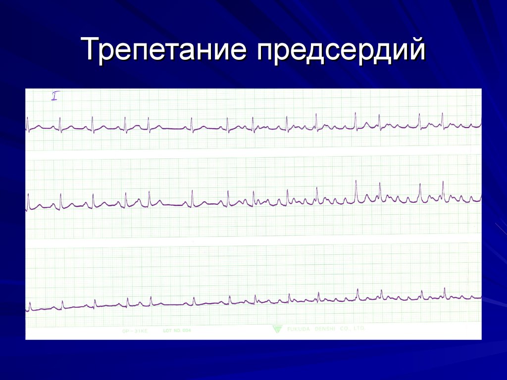 Фибрилляция предсердий на экг. Трепетание предсердий 2 к 1 на ЭКГ. Ритм трепетания предсердий ЭКГ. Трепетание предсердий ЭКГ снимок. ЭКГ типичное трепетание предсердий 2:1.