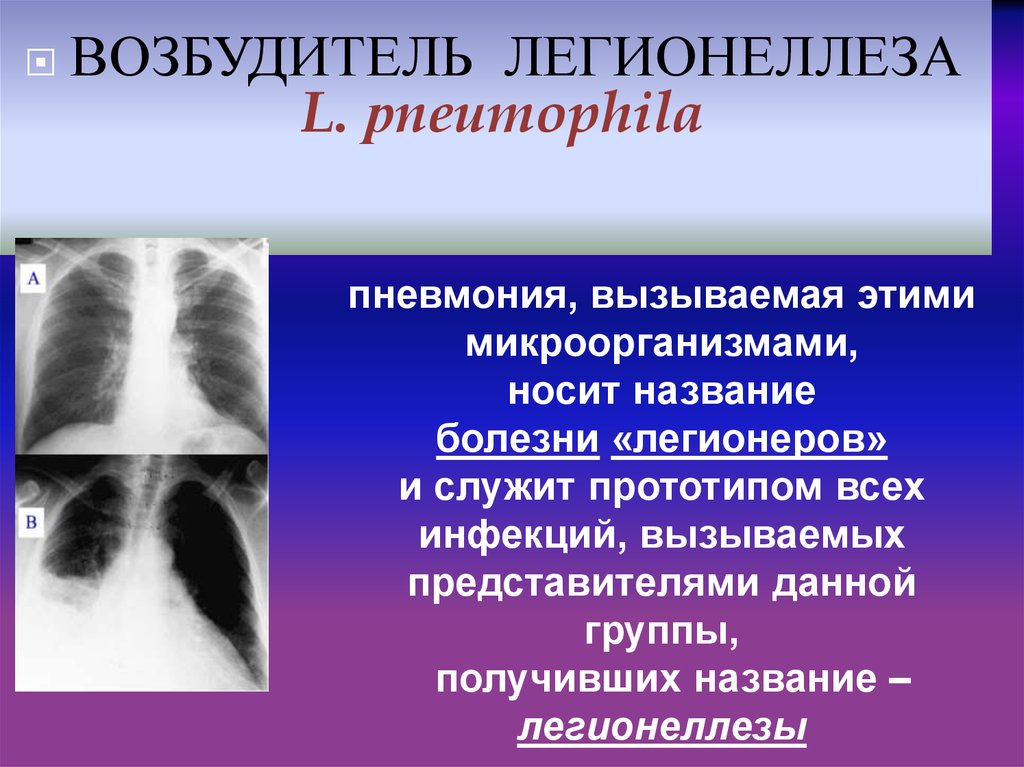 Внебольничная пневмония возбудители. Легионеллез пневмония. Для лечения пневмонии, вызванной Legionella pneumophila применяют. Болезнь легионеров история названия. 10. Для лечения пневмонии, вызванной Legionella pneumophila применяют.