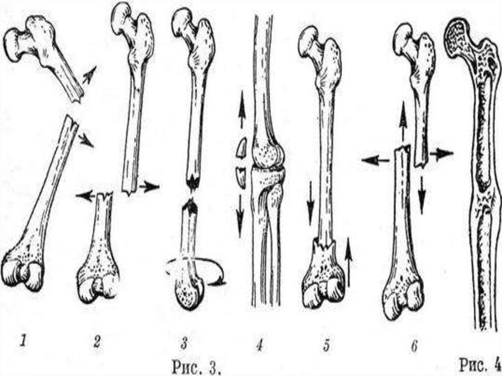 Трубчатая кость пальца. Диафизарный перелом плечевой кости. Перелом трубчатой кости. Перелом трубчатых костей диафиза. Вколоченный перелом плечевой кости.