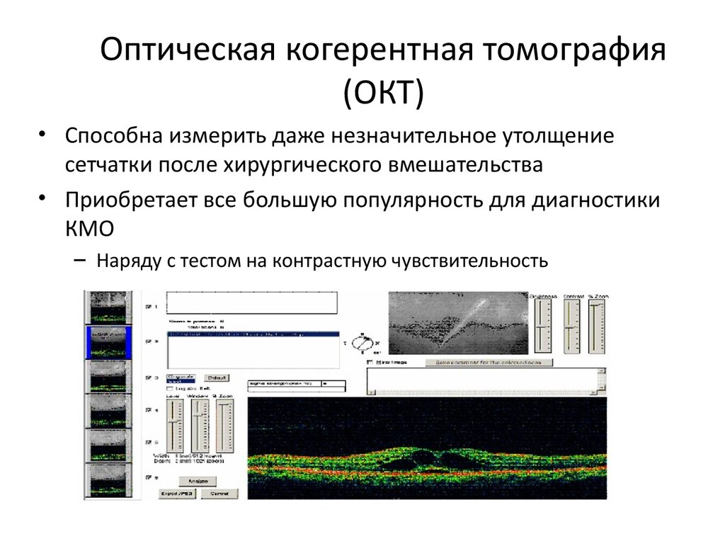 Когерентная томография