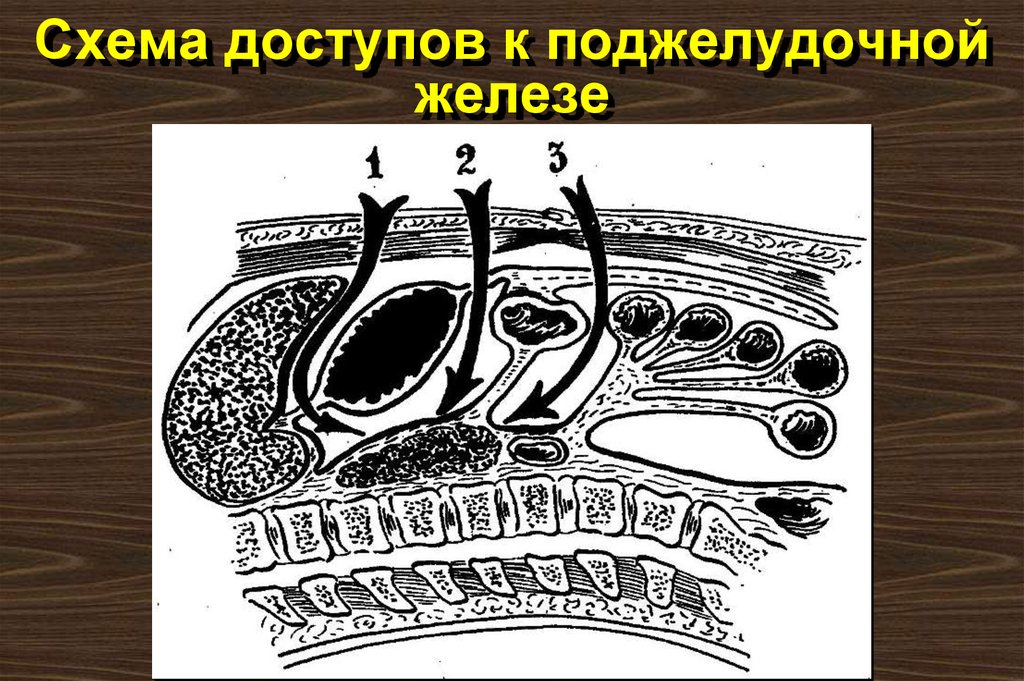 Схема доступов к поджелудочной железе
