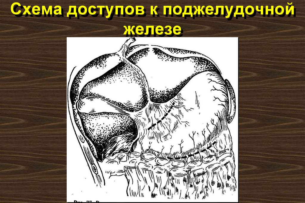 Схема доступов к поджелудочной железе