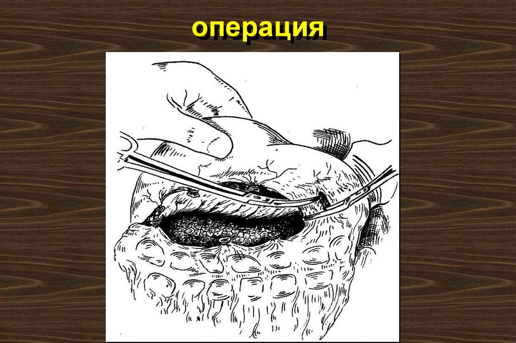 операция