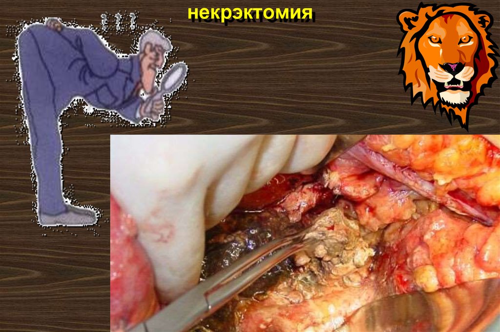 некрэктомия