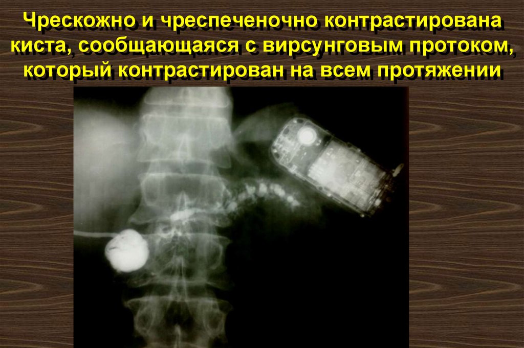 Чрескожно и чреспеченочно контрастирована киста, сообщающаяся с вирсунговым протоком, который контрастирован на всем протяжении