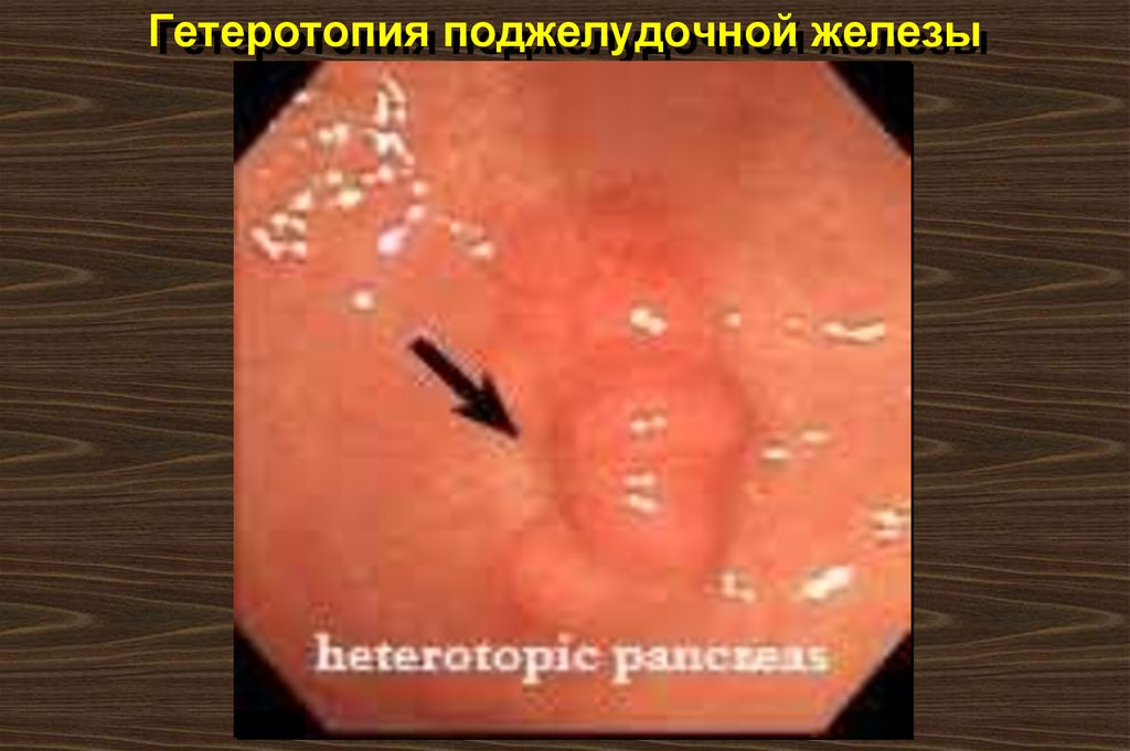 Гетеротопия поджелудочной железы