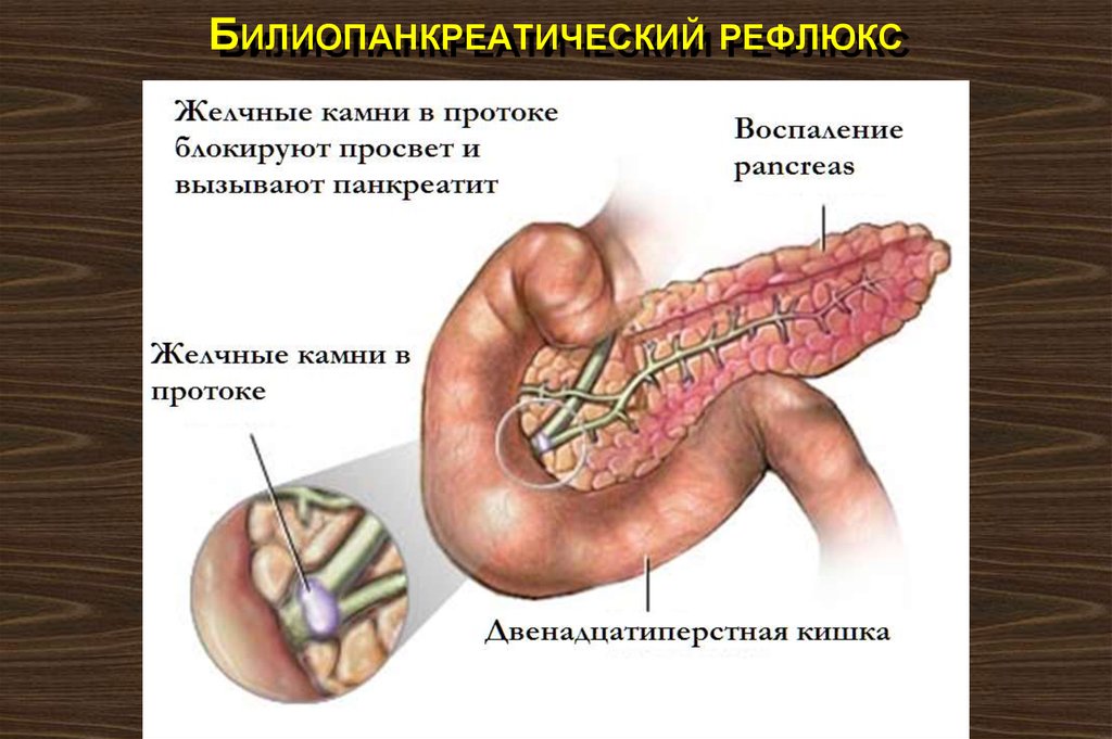 Билиопанкреатический рефлюкс