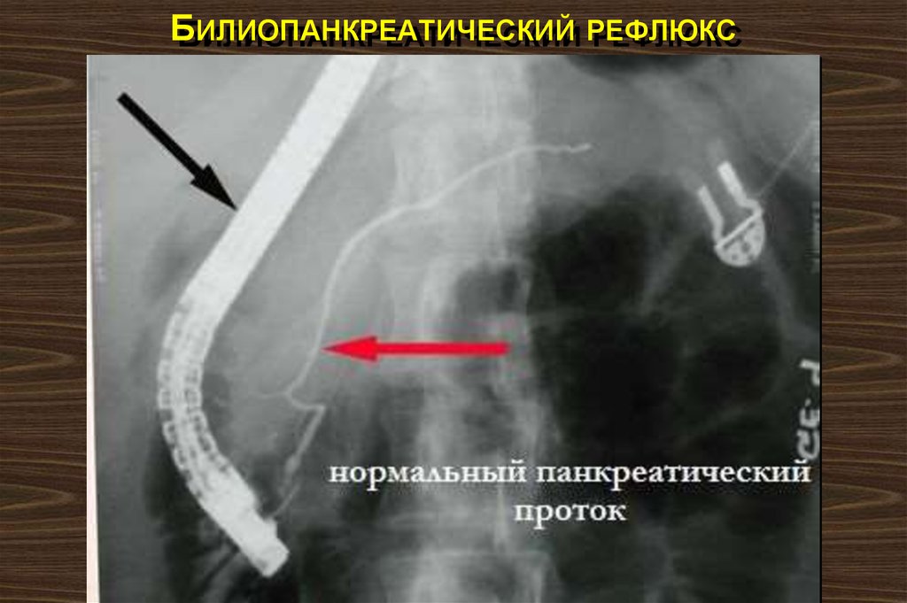 Билиопанкреатический рефлюкс