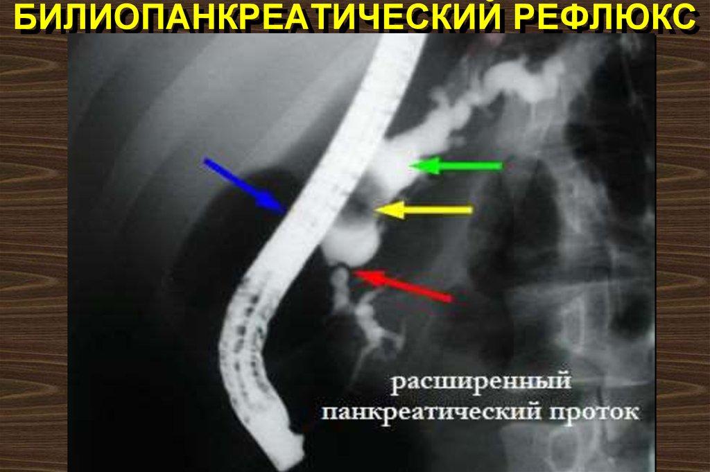Билиопанкреатический рефлюкс