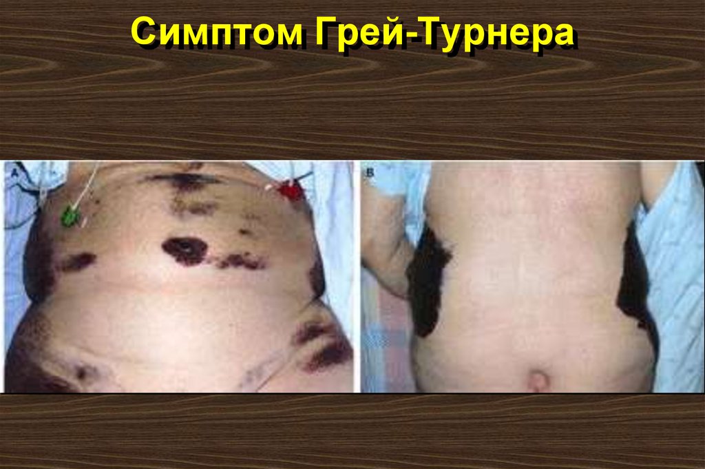 Симптом Грей-Турнера