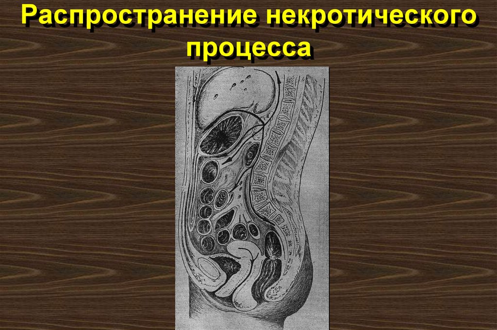 Распространение некротического процесса