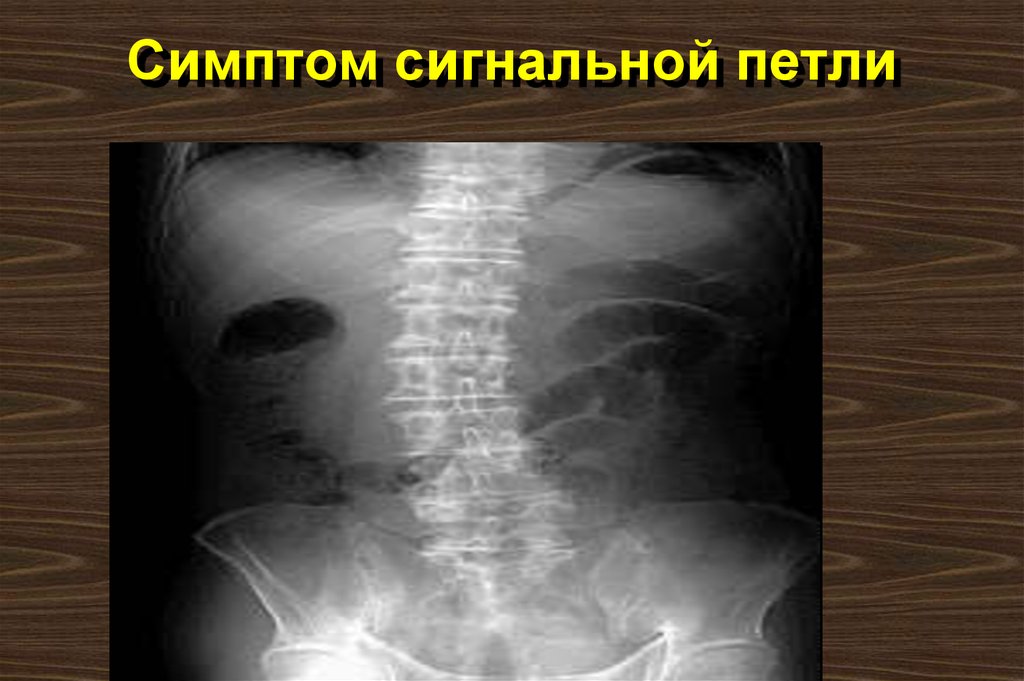 Симптом сигнальной петли