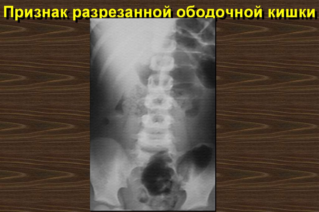 Признак разрезанной ободочной кишки