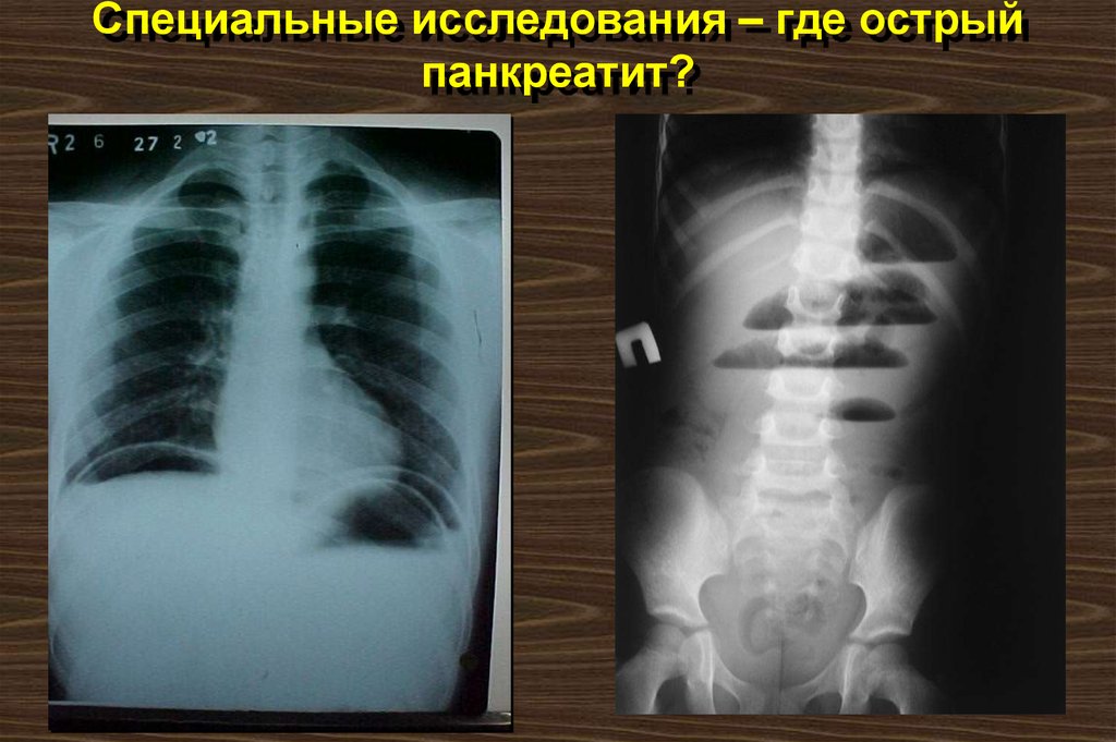 Специальные исследования – где острый панкреатит?