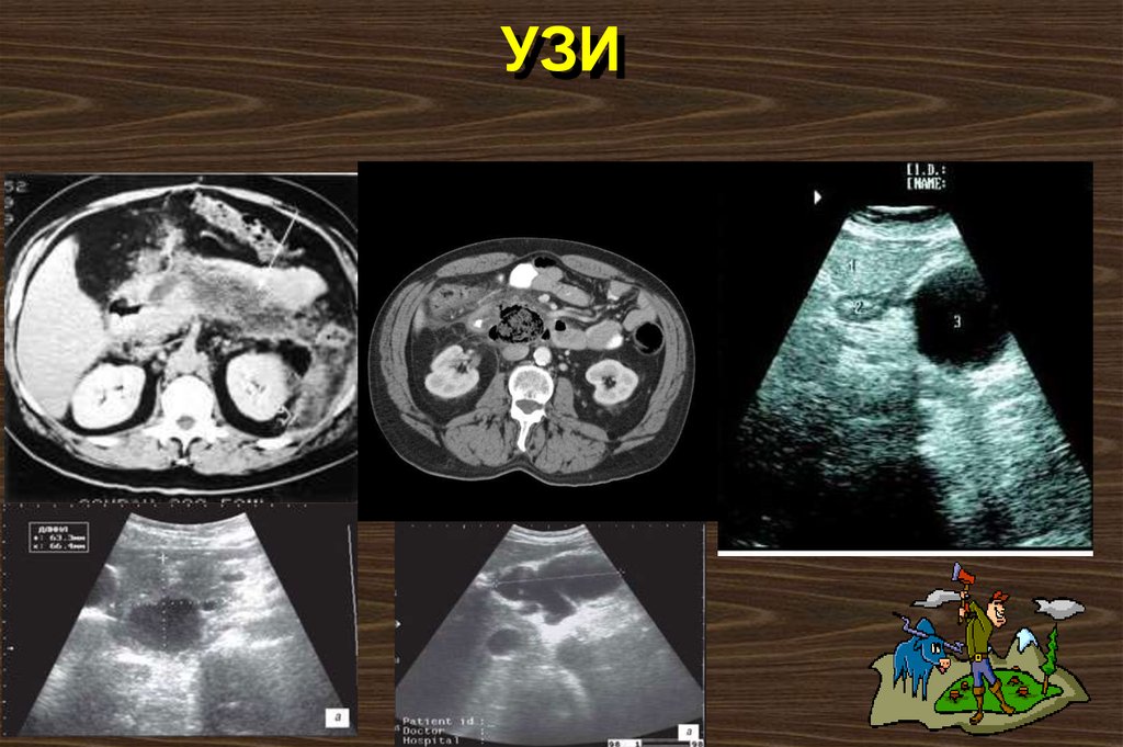 УЗИ