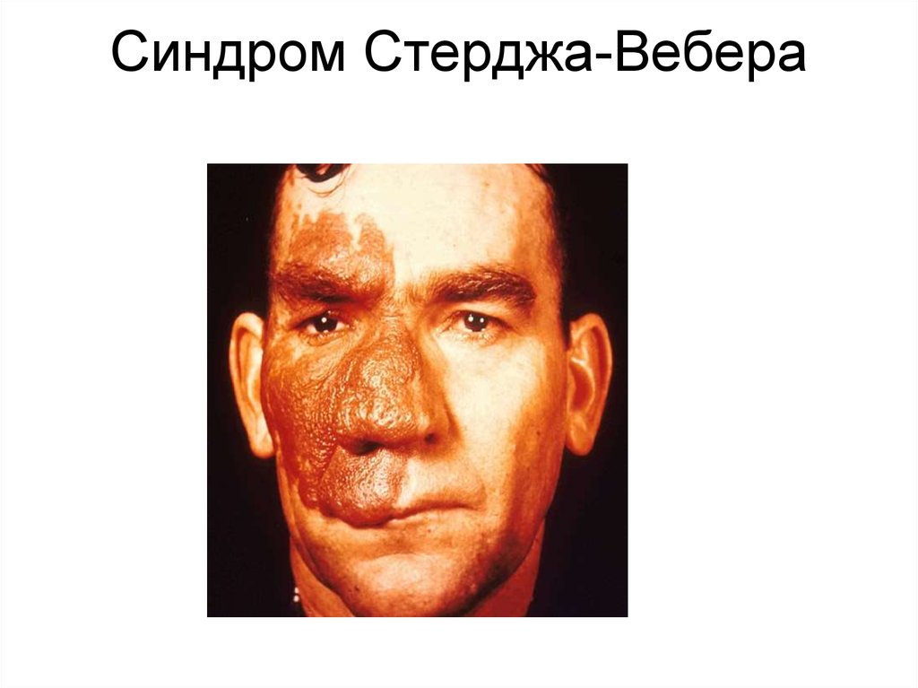 Штурге вебера