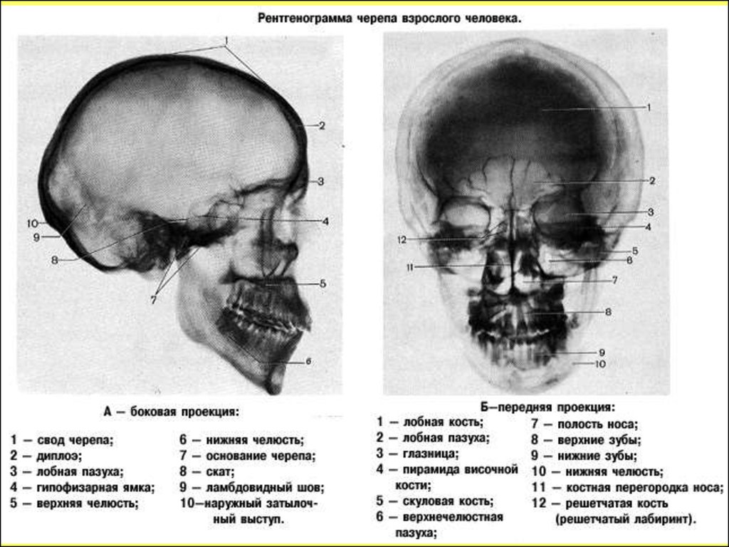 Проекция черепа. Рентгенограмма черепа в боковой проекции схема. Череп в боковой проекции рентген анатомия. Рентген черепа норма спереди. Кости черепа рентген анатомия.