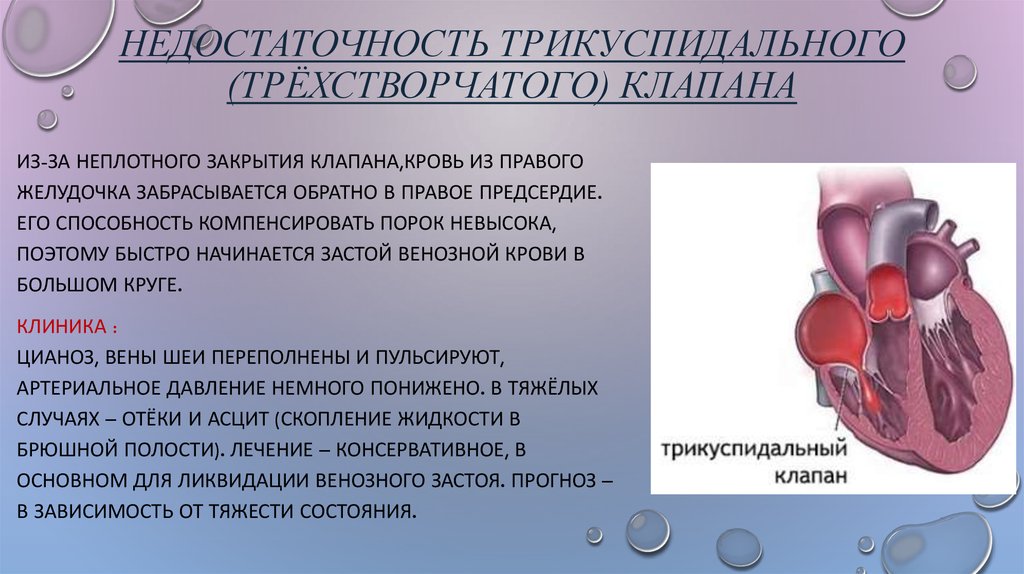 Сердца степени. Порок сердца недостаточность трехстворчатого клапана. Недостаточность трикуспидального клапана. Клинические симптомы недостаточности трикуспидального клапана. Сердечная недостаточность 1 степени клапана.