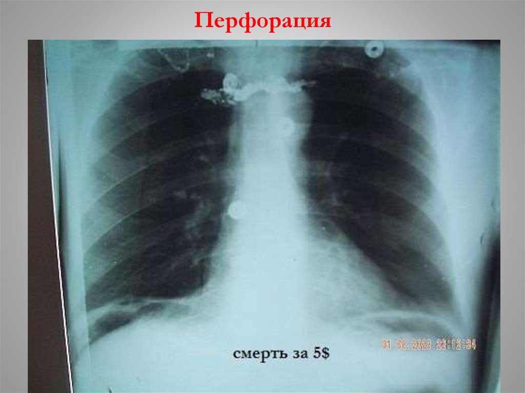 Перфорация