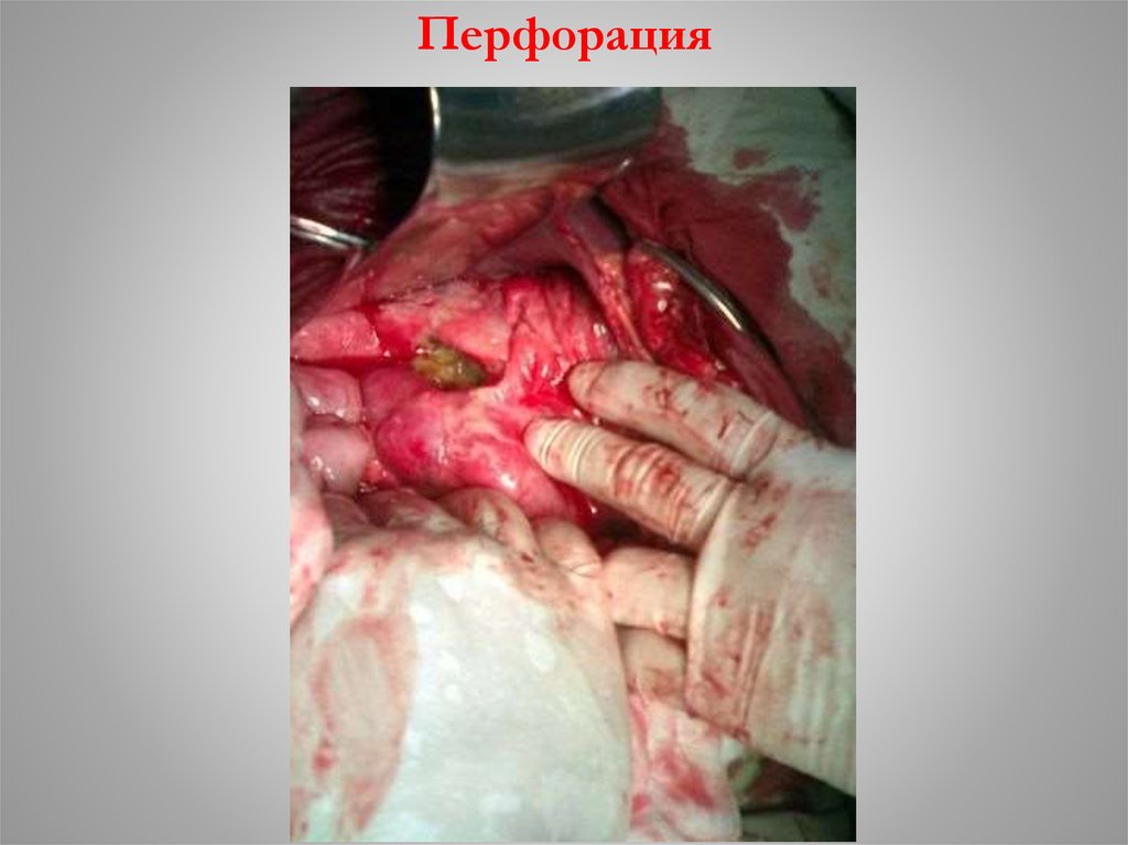 Перфорация