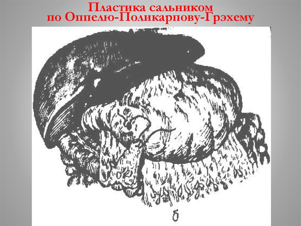 Пластика сальником по Оппелю-Поликарпову-Грэхему