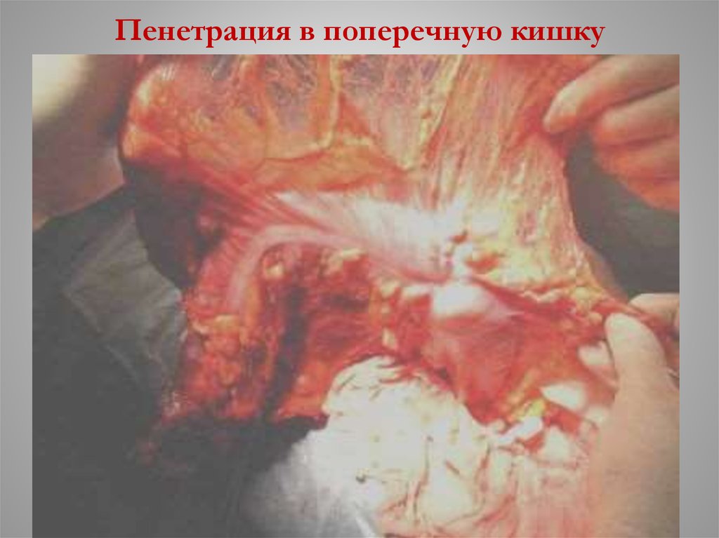 Пенетрация в поперечную кишку