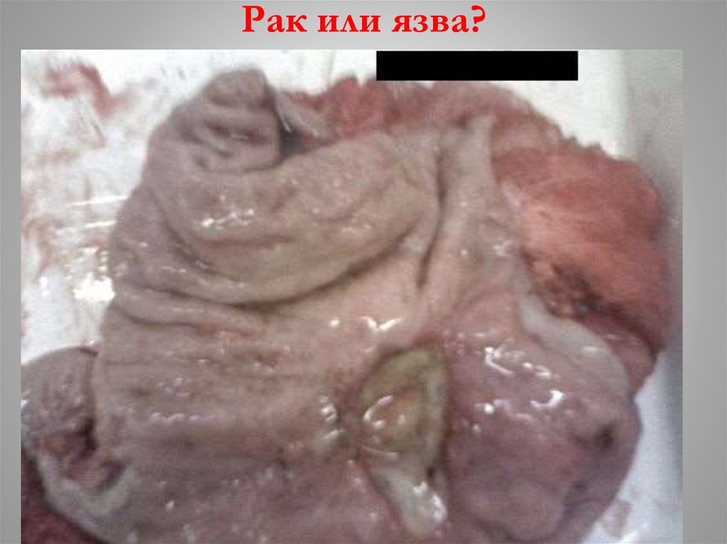 Рак или язва?