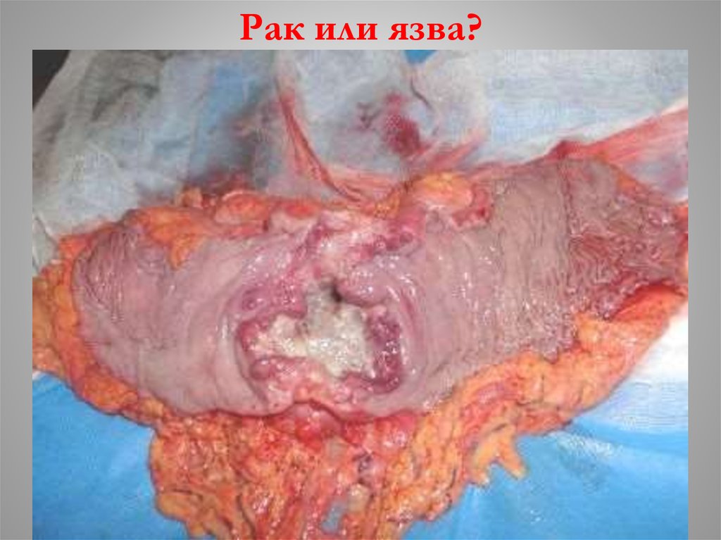 Рак или язва?